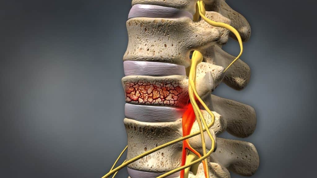 Lendenwirbelfraktur, die Stenose verursacht (3/4 Seitenansicht)