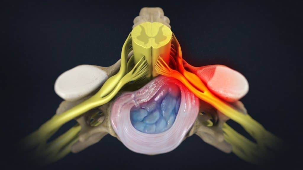 Cervical Radiculopathy: Causes, Symptoms & Treatment