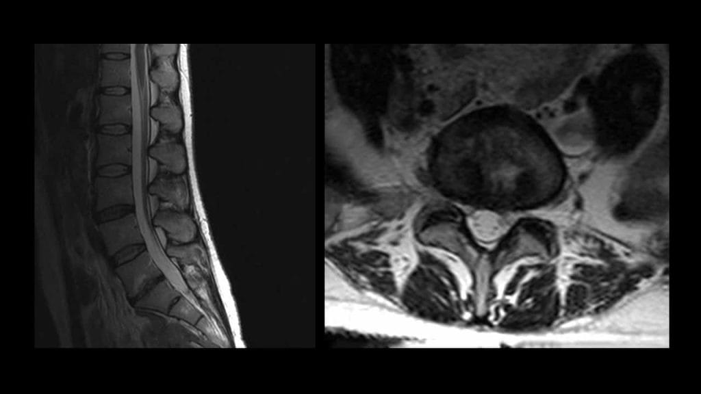 Sagittal and axial T2-weighted MRI images, obtained 7 months later, showing significant resolution of the disc herniation