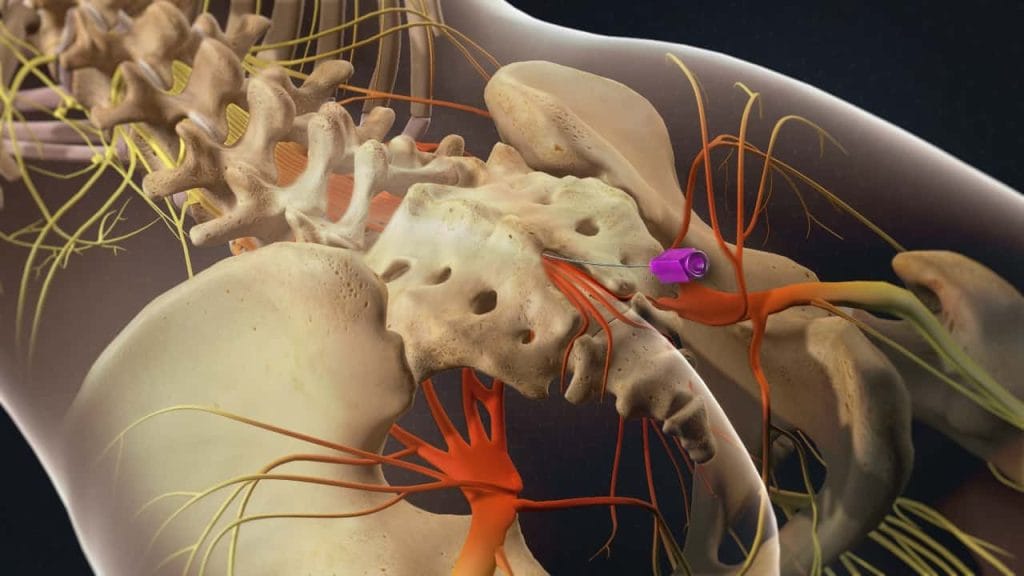 Ιερό σχίσμα με εισαγωγή βελόνας (προοπτική απεικόνιση)