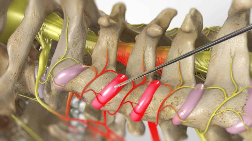 Zervikale Facetteninfiltration