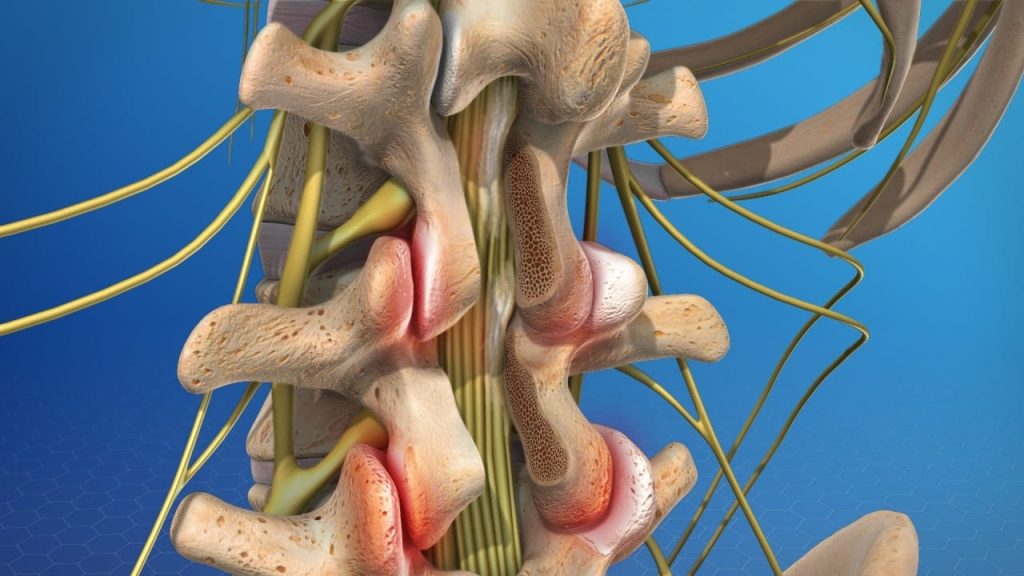 Failed Back Surgery Syndrome (FBSS): Causes, Symptoms & Treatment