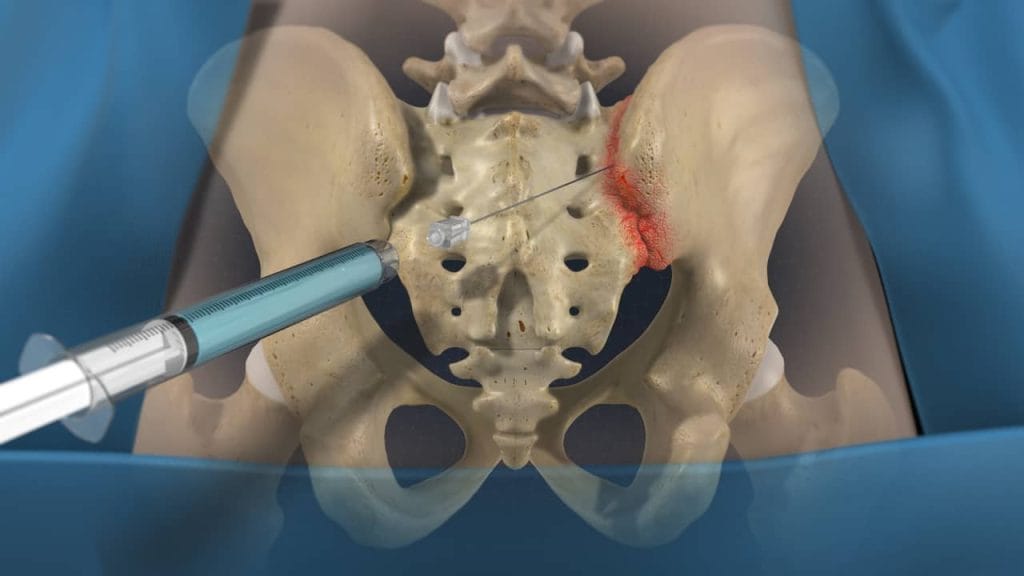 Τοποθέτηση της σύριγγας για διήθηση της ιερολαγόνιας άρθρωσης