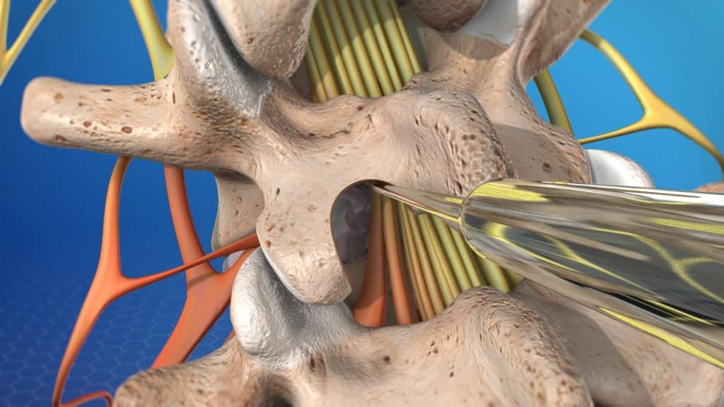 Lumbar disc microsurgery (placement of instrument)Lumbar disc microsurgery (placement of instrument)