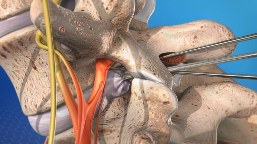 Lumbar disc microsurgery (removal of a herniated disc)