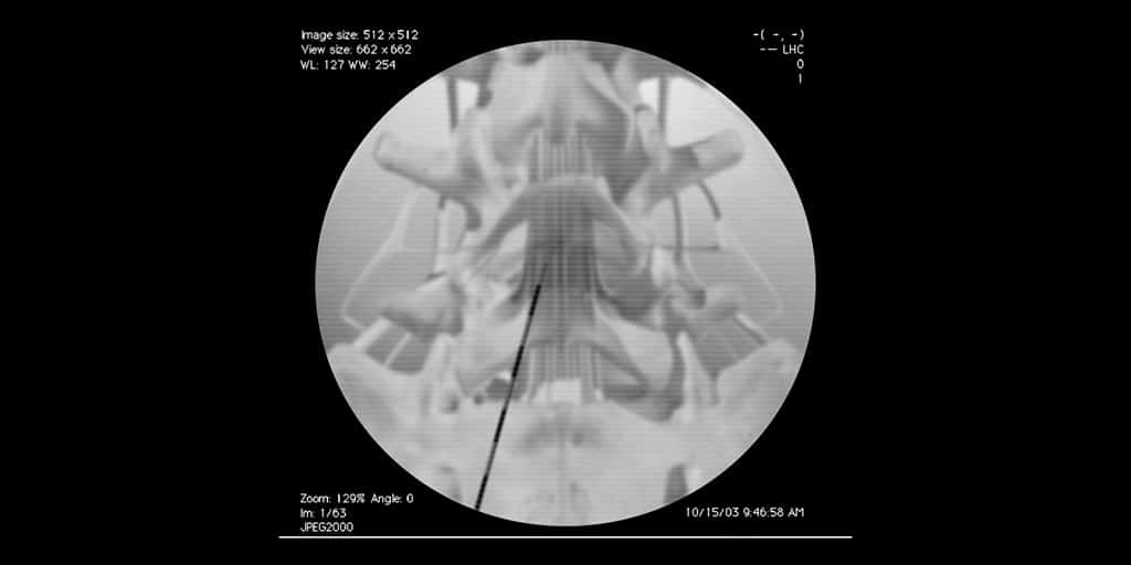 Οσφυϊκή οπίσθια (διαπεταλική) επισκληρίδιος έγχυση (ακτινοσκοπική εικόνα)