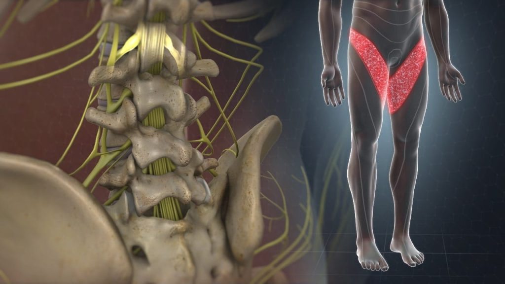 L2 Dermatom – L2 Radikulopathie