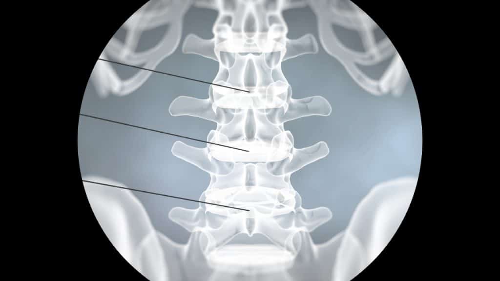 Diskographie (Nadeleinführung, fluoroskopische Aufnahme)