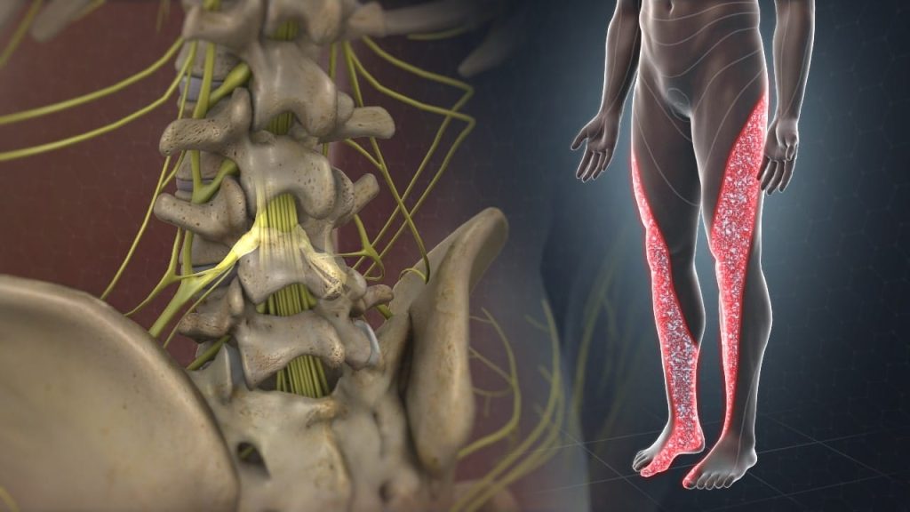 Lumbale Radikulopathie (Ischialgie)