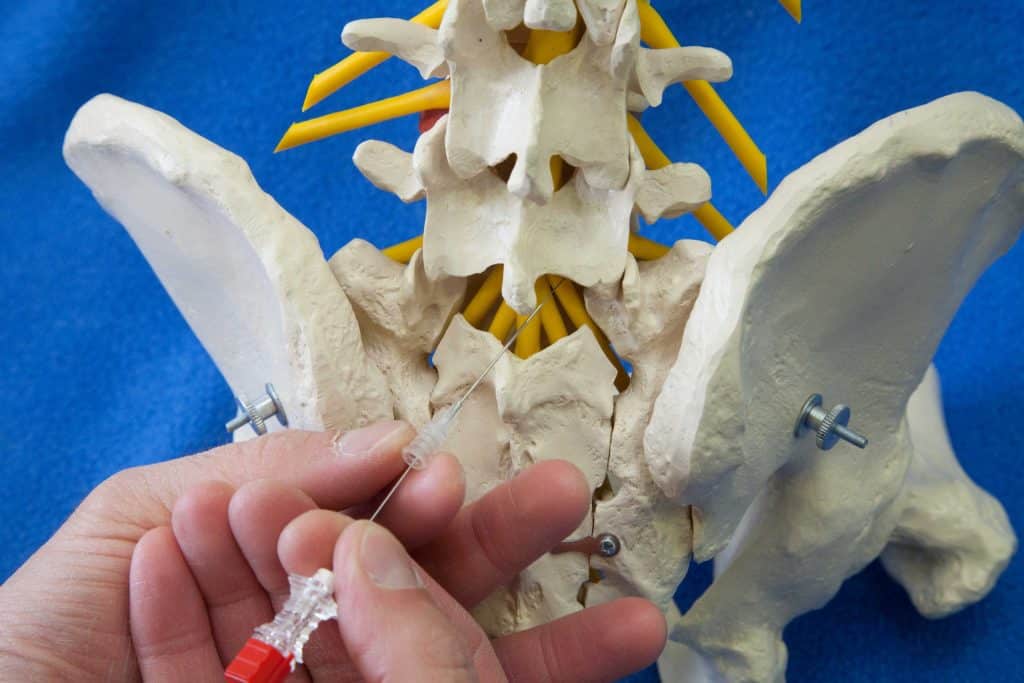 Επισκληρίδιος περινευρική έγχυση (τοποθέτηση βελόνας εισαγωγής)