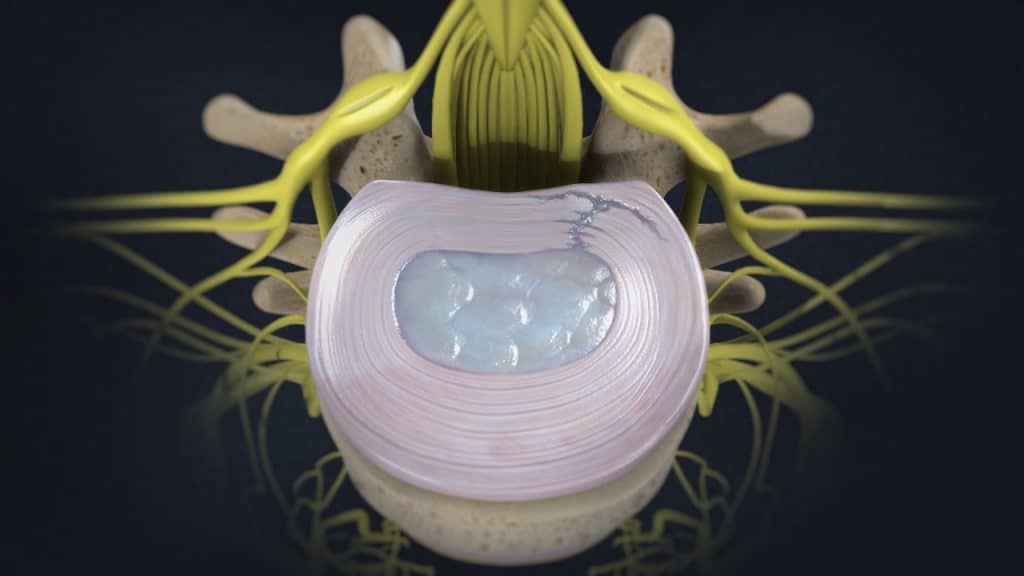 Lumbale Bandscheibe mit geschwächtem Faserring (Ansicht von oben)