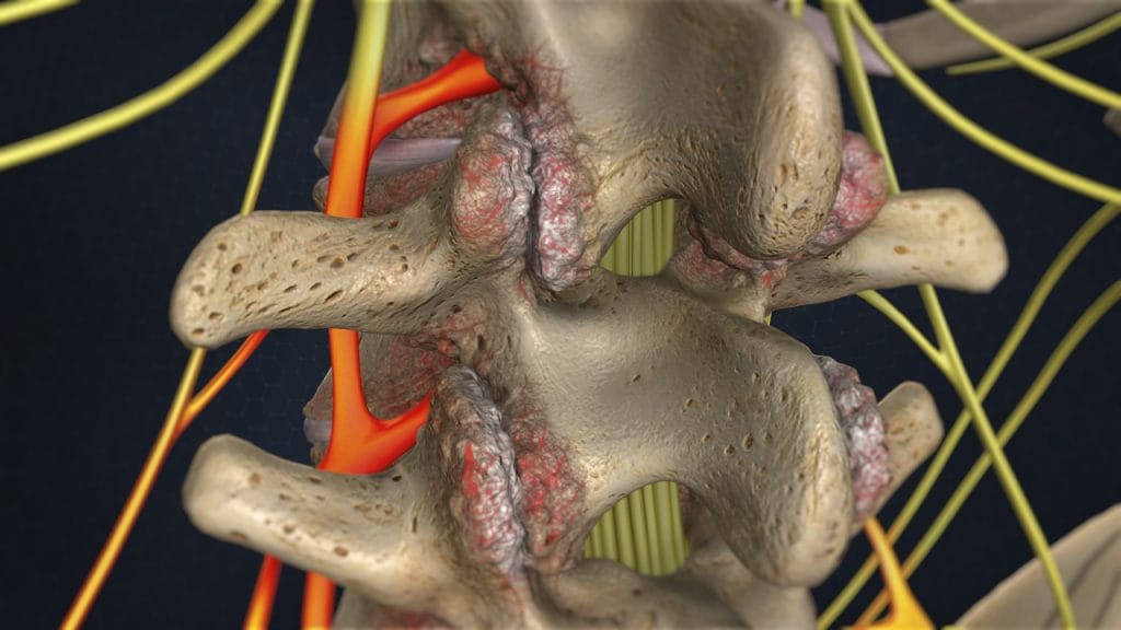Lendenwirbel mit Osteophyten (Arthritis der Lendenwirbelsäule)