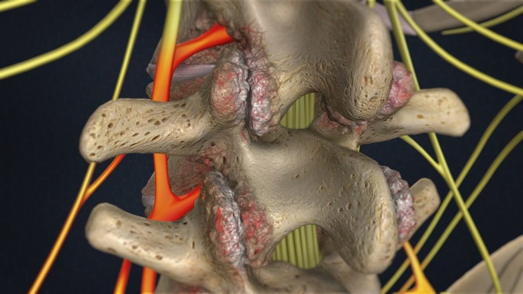 Lendenwirbel mit Osteophyten (Arthritis der Lendenwirbelsäule)