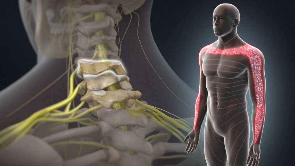 C5 Dermatom – C5 Radikulopathie