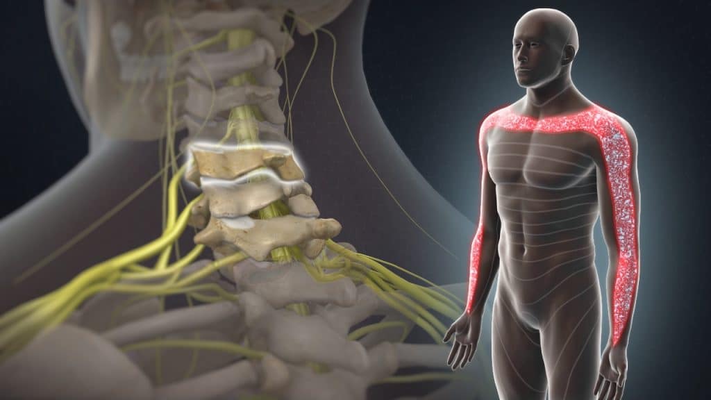 C5 Dermatom – C5 Radikulopathie