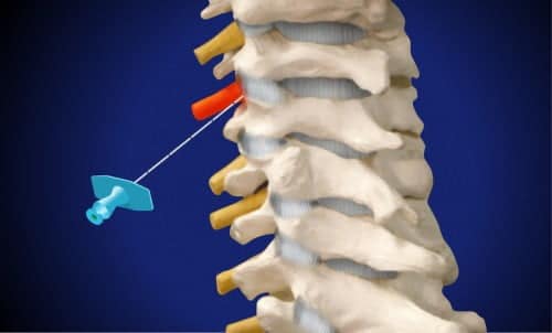 Αναλγησία αυχενικού νωτιαίου νεύρου (ερεθισμένη και επώδυνη νευρική ρίζα, τοποθέτηση βελόνας)