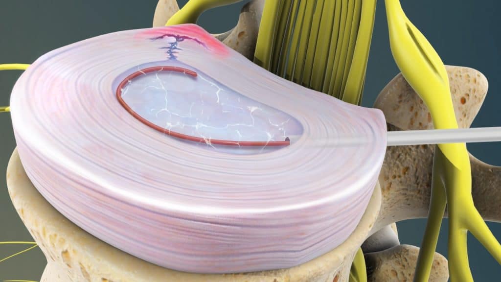 Intradiskale elektrothermale Therapie (Einführung der Radiofrequenzsonde über die Kanüle)