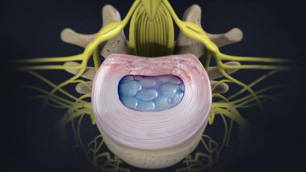 Lendenwirbel mit Faserring kurz vor dem Riss (Ansicht von oben)