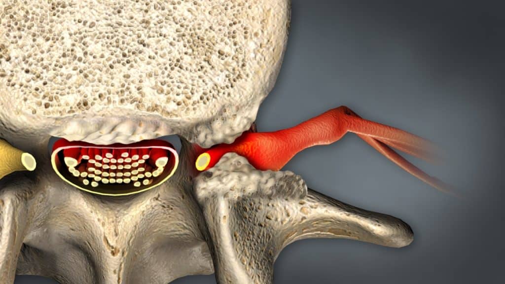 Nahansicht des Lendenwirbels mit zentraler Stenose und Foramenstenose (Ansicht von oben)
