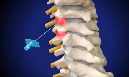 Έγχυση στις αυχενικές ζυγοαποφυσιακές αρθρώσεις (βελόνα στην πάνω άρθρωση)