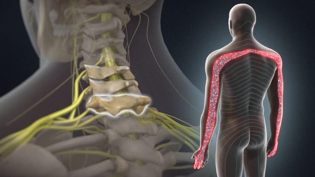 C7 Dermatom – C7 Radikulopathie