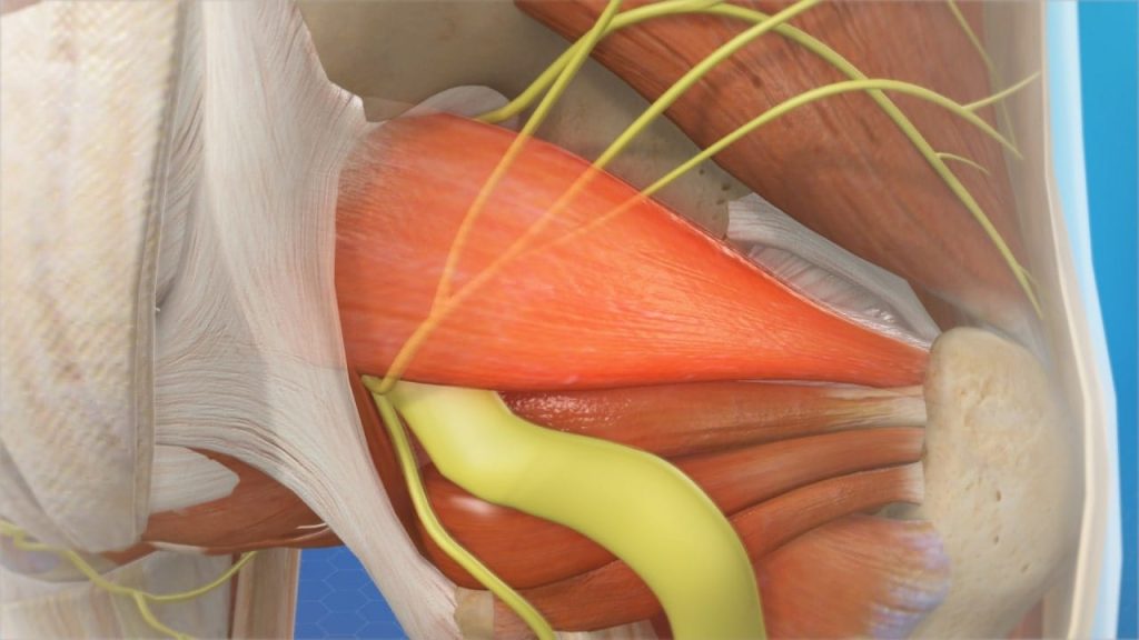 Piriformis syndrome