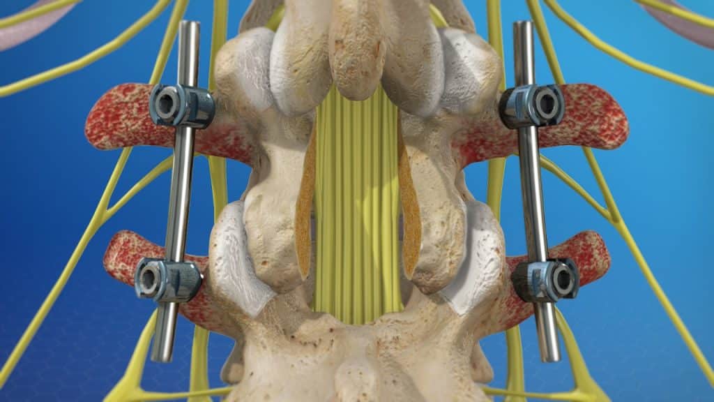 Spinal fusion and laminectomy