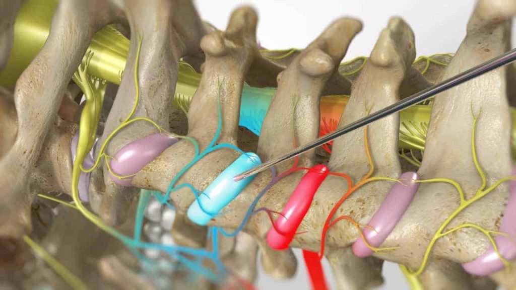 Zervikale Facetteninfiltration (Schmerzlinderung)