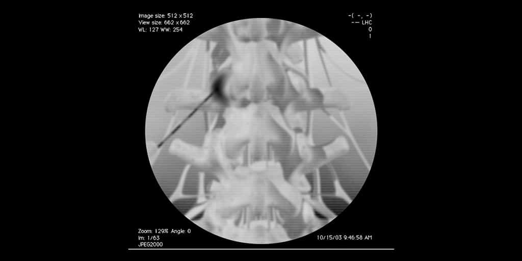 Έγχυση ζυγοαποφυσιακής άρθρωσης (ακτινοσκοπική εικόνα)