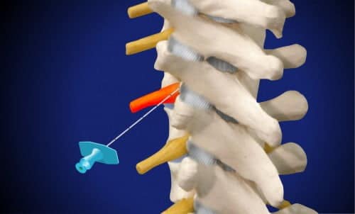 Αναλγησία θωρακικού νωτιαίου νεύρου (ερεθισμένη και επώδυνη νευρική ρίζα, τοποθέτηση βελόνας)