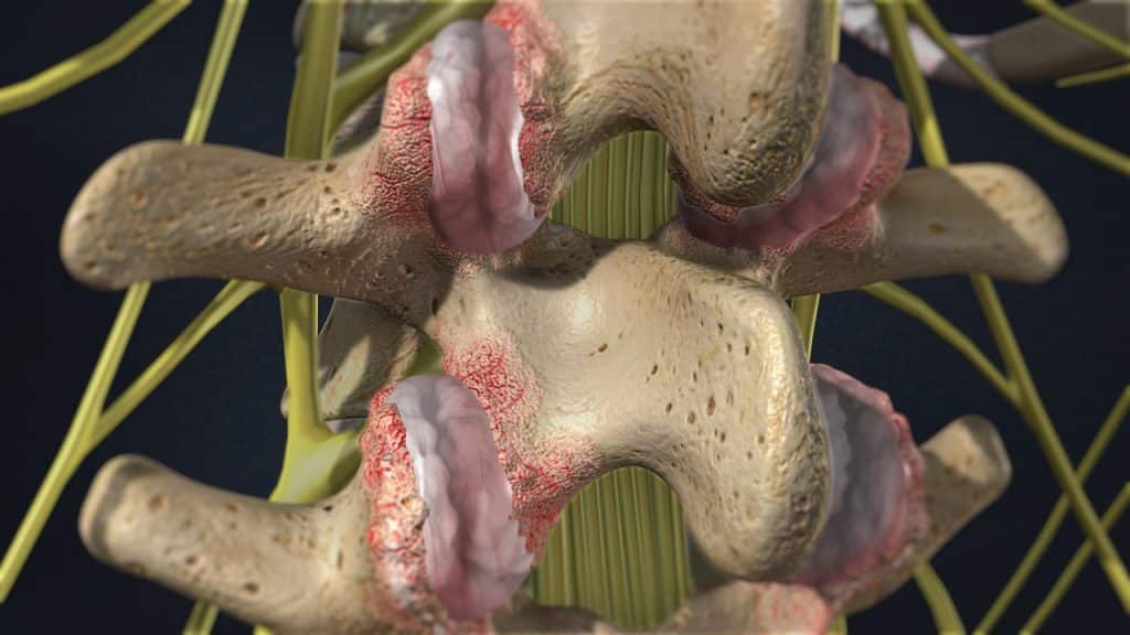 Σύνδρομο ζυγοαποφυσιακών αρθρώσεων (αρθρώσεις και θύλακοι με φλεγμονή)