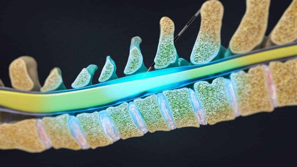 Zervikale interlaminäre epidurale Injektion (Schmerzlinderung)