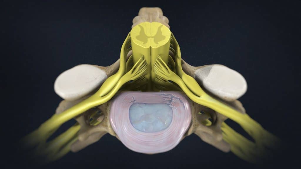 C5 Диск (разрывы/трещины кольца)