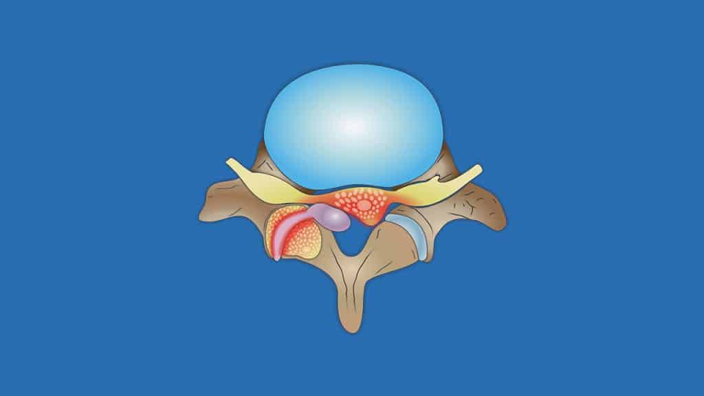 Synovial cyst of the spine (schematic illustration)