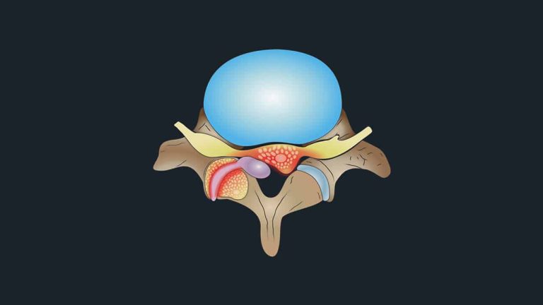 Synovial Cyst of the Spine