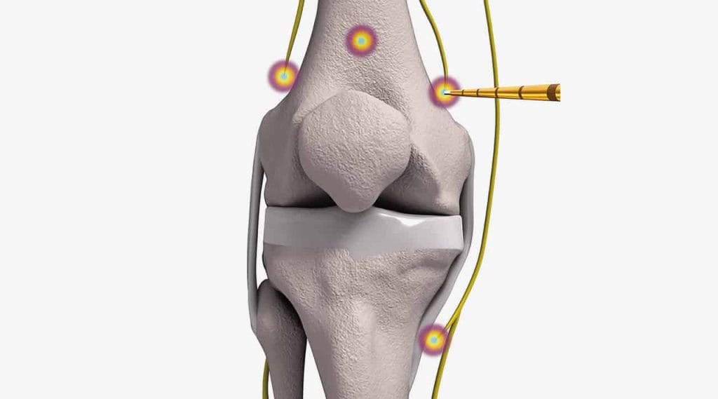 COOLIEF* COOLED RADIOFREQUENCY TREATMENT FOR OSTEOARTHRITIS KNEE PAIN