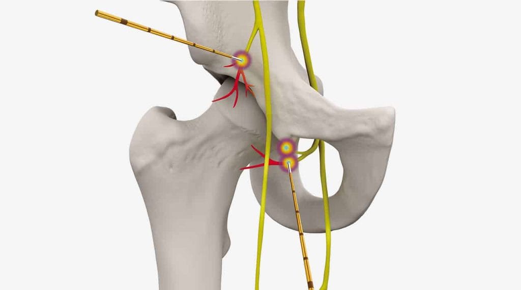 COOLIEF* COOLED RADIOFREQUENCY TREATMENT FOR OSTEOARTHRITIS HIP PAIN