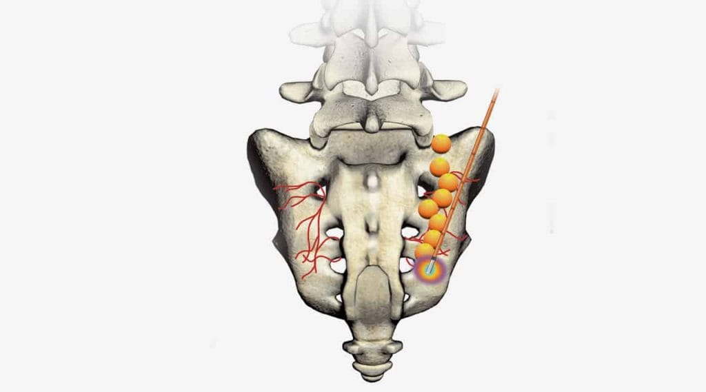 COOLIEF* COOLED RADIOFREQUENCY TREATMENT FOR CHRONIC SACROILIAC JOINT PAIN