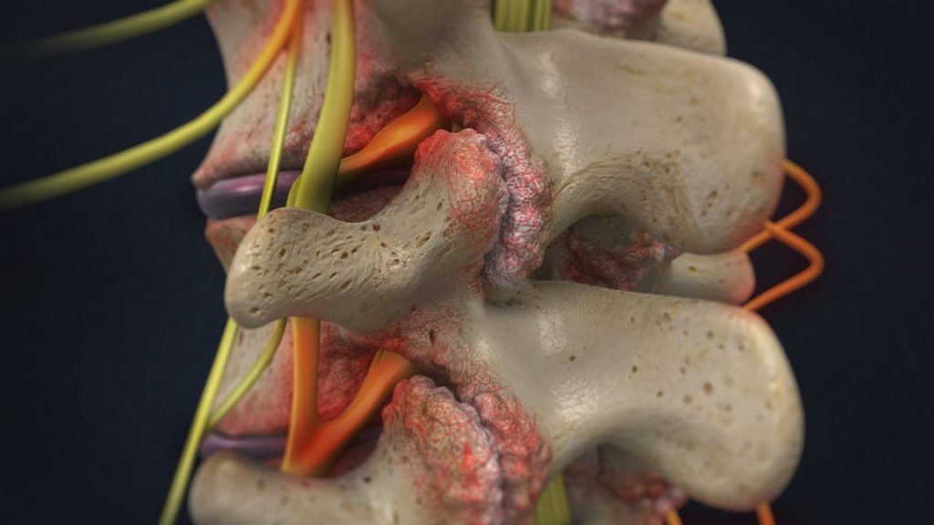 Lumbale Spinalstenose