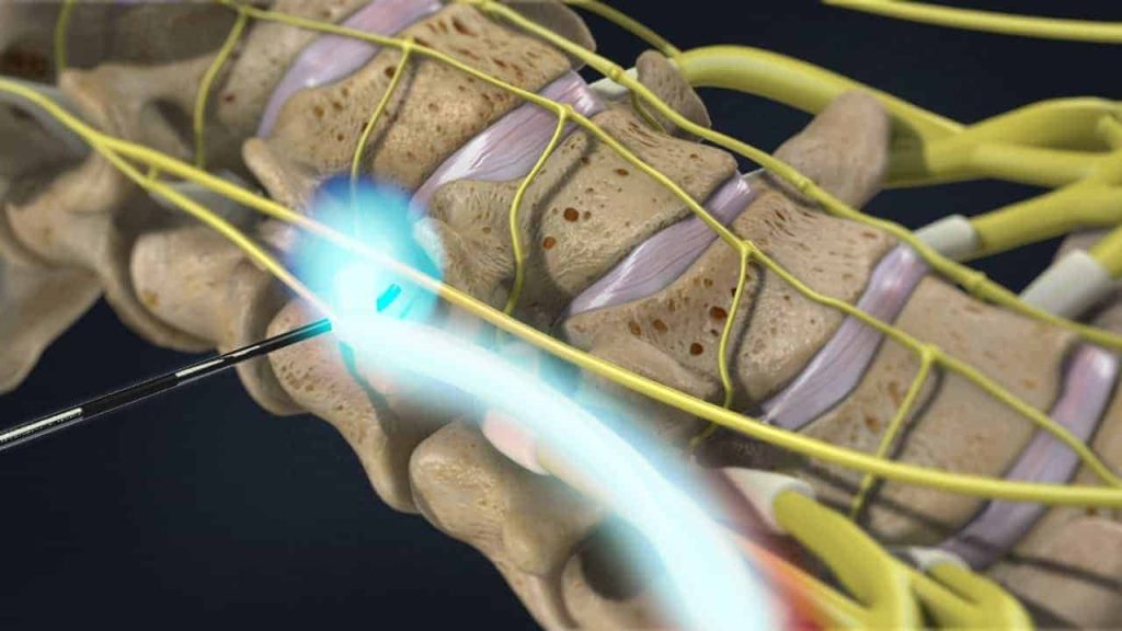 Zervikale transforaminale epidurale Injektion (Desensibilisierung der gereizten Nervenwurzel)