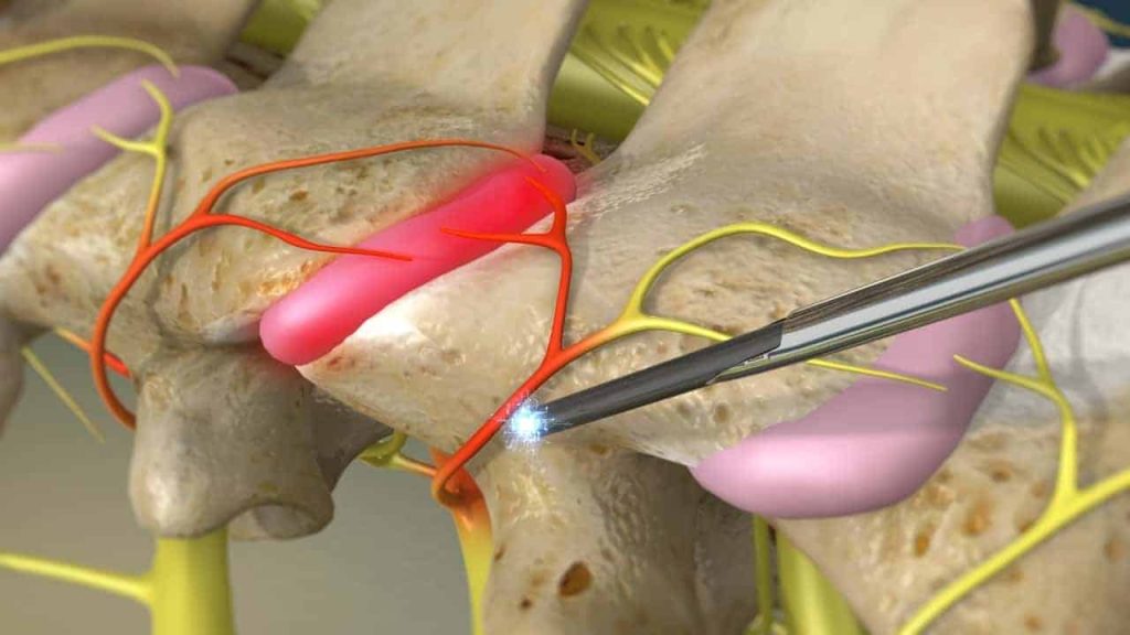 Radiofrequency neurotomy (probe activated)