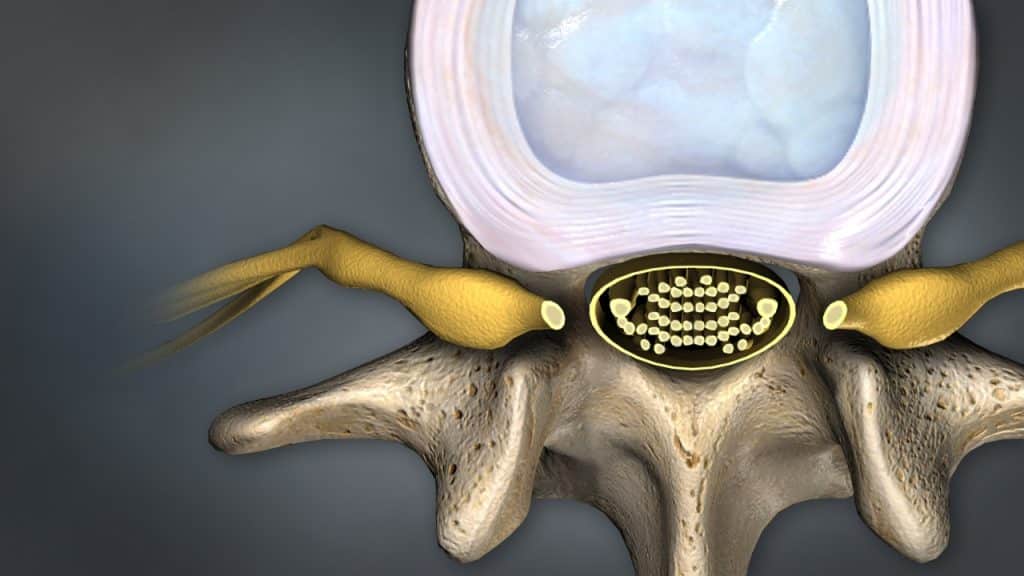 Nahansicht des Lendenwirbels mit Bandscheibe, Cauda equina und Nervenwurzeln (Ansicht von oben)