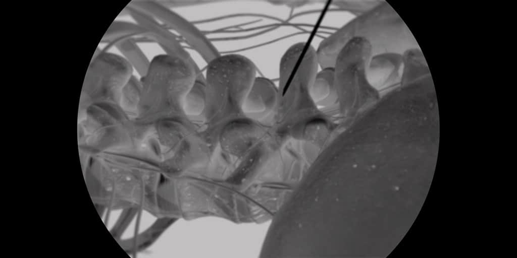 Νευροτομή με ραδιοσυχνότητα (ακτινοσκοπική εικόνα)