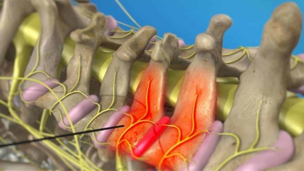 Infiltration des medialen Nervenastes (Platzierung der Nadel)