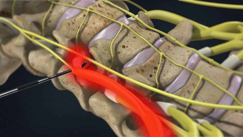 Zervikale transforaminale epidurale Injektion (gereizte und schmerzhafte Nervenwurzel)