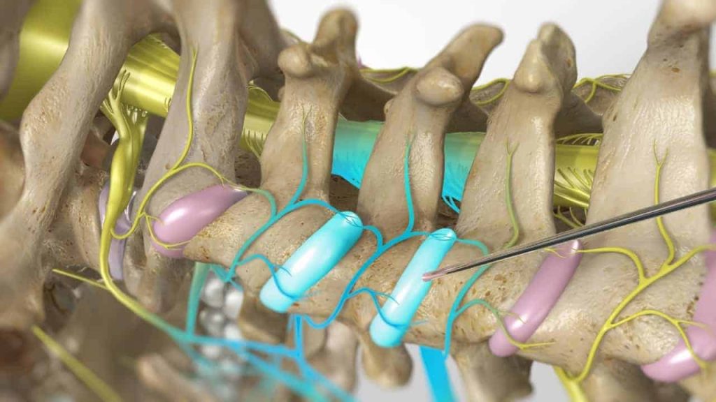 Zervikale Facetteninfiltration (zwei Ebenen, Schmerzlinderung)