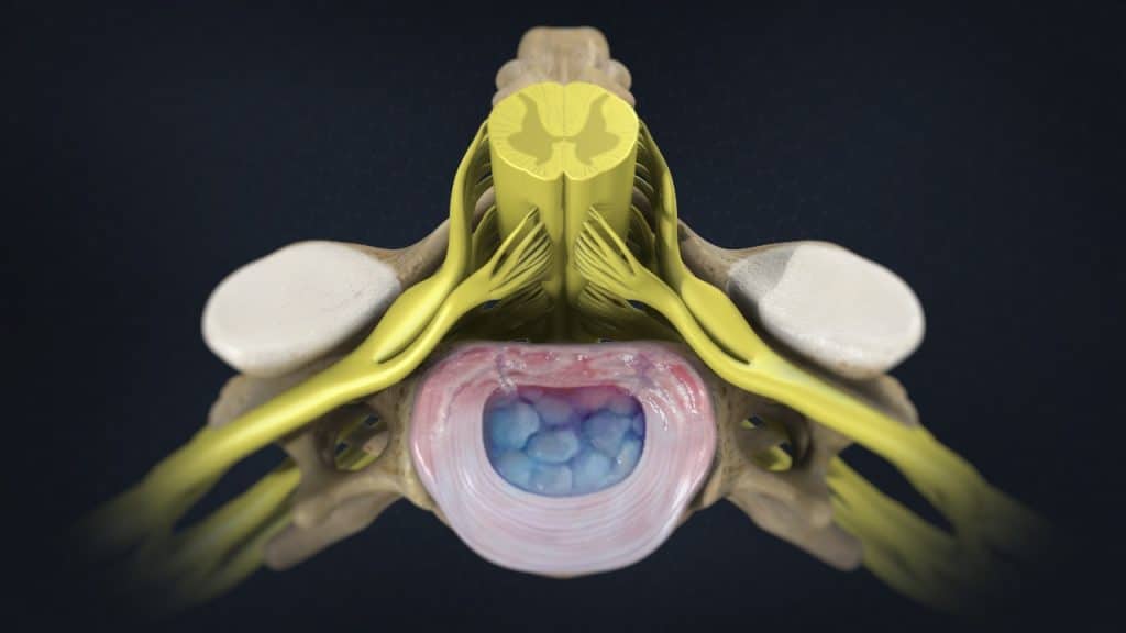 C5 Диск (разрывы/трещины кольца, рубцевание, утечка жидкости пульпозного ядра)