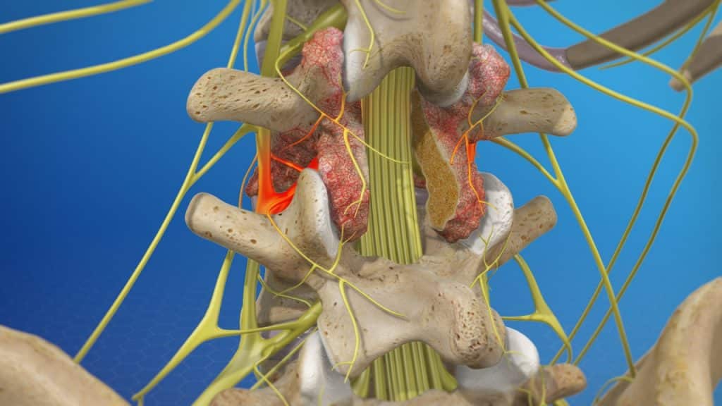 Laminectomy of arthritic spine