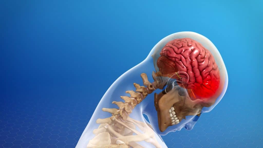 Schleudertrauma (Kopf nach vorne)