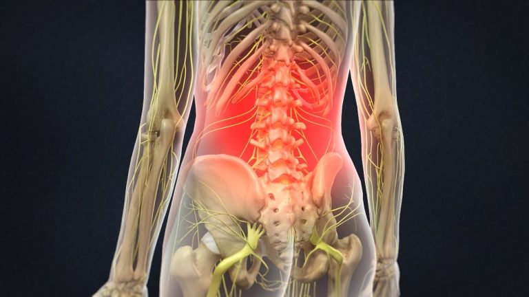 Low Back Pain (Lumbago)